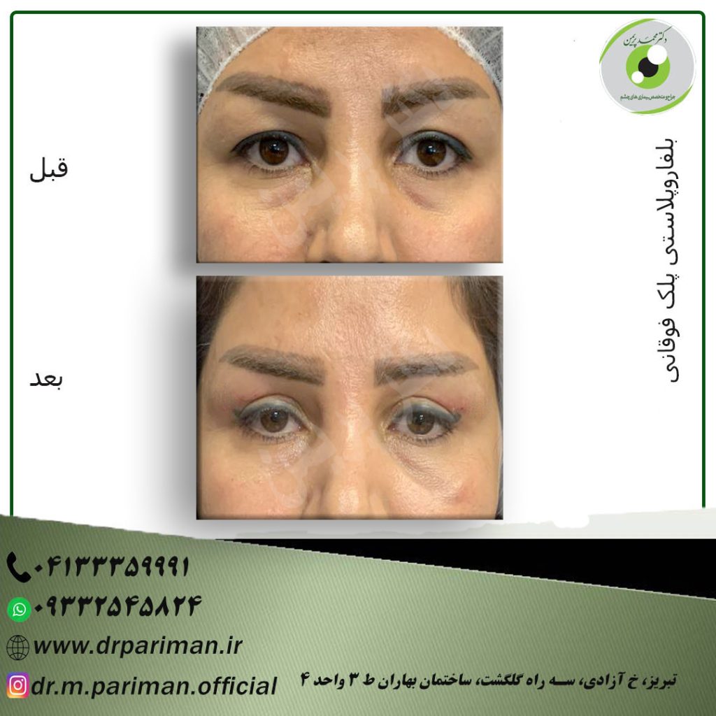 بلفاروپلاستی تبریز