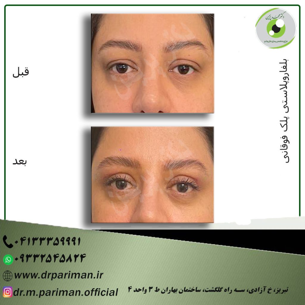 بلفاروپلاستی پلک تحتانی در تبریز