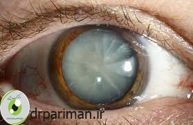 کاتاراکت چشم - دکتر محمد پریمن