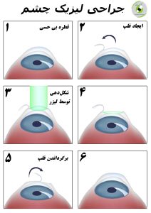 جراحی لییزک چشم
