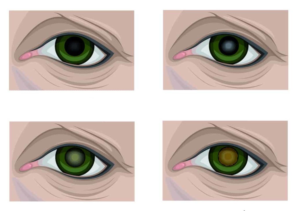 مراحل پیشرفت آب مروارید چشم
آب مروارید خفیف