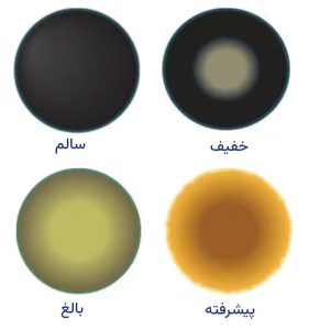 آب مروارید