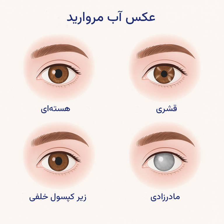 آب مروارید چیست
عکس آب مروارید